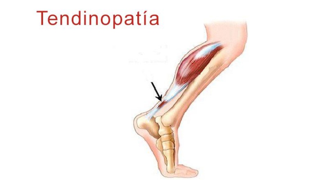 Tendinopatía - Fisioterapia Ana Hueso