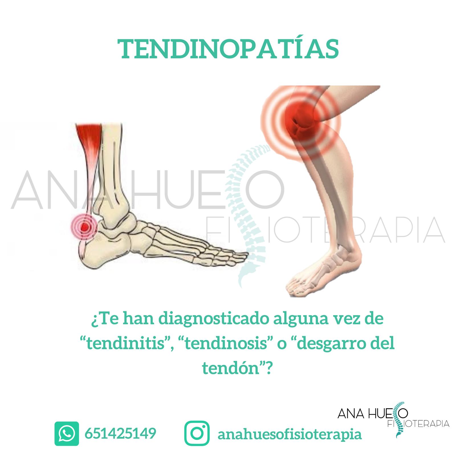 Tendinopatía - Fisioterapia Ana Hueso